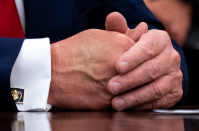 Bruising on Trump's right hand on July 15, 2020