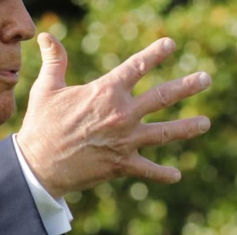 Bruising and makeup(?) on Trump's right hand on July 23, 2020