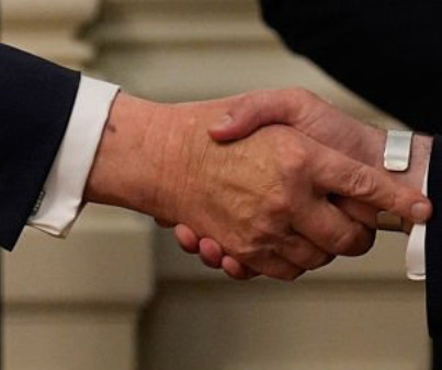 Bruising visible on Trump's right forearm on July 22, 2025