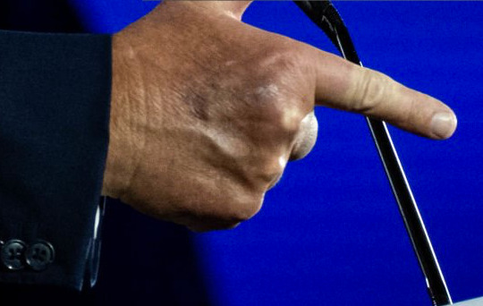A bruise on the back of Trump's hand on June 17, 2022
