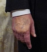 Bruising evident on Trump's hand as the makeup has worn off during his visit to the king of England (Sept 17, 2025).
