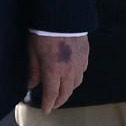 Bruising on the back of Trump's left hand
